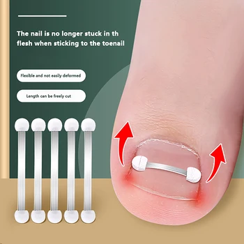 Įaugęs kojų nagų korektorius Ortodontinis pedikiūras Atkurti Įterpti Kojų nagų gydymas Pro Įaugusių kojų nagų korekcija Pėdų nagų pleistras